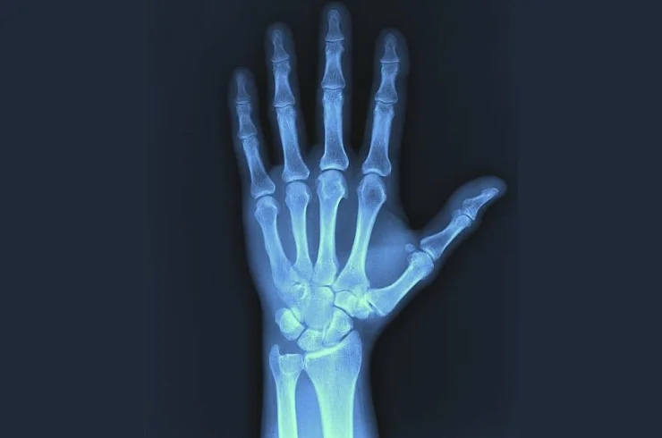 Xrays -----11